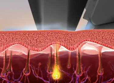 従来の脱毛方式 (HR モード)