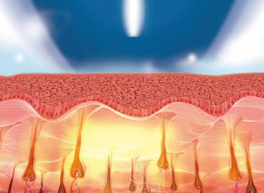 蓄熱脱毛®方式 (SHR モード)