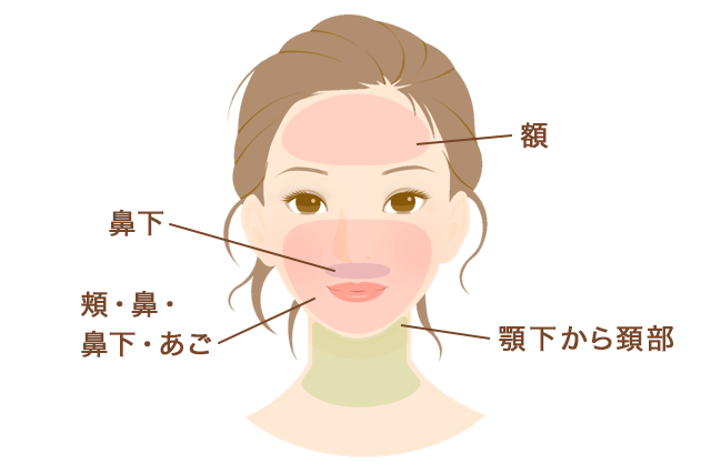 脱毛部位境界図